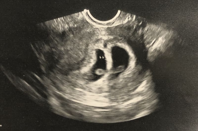 双子妊娠ブログ 4週 15週の様子 初期の不安やエコー写真 旅する