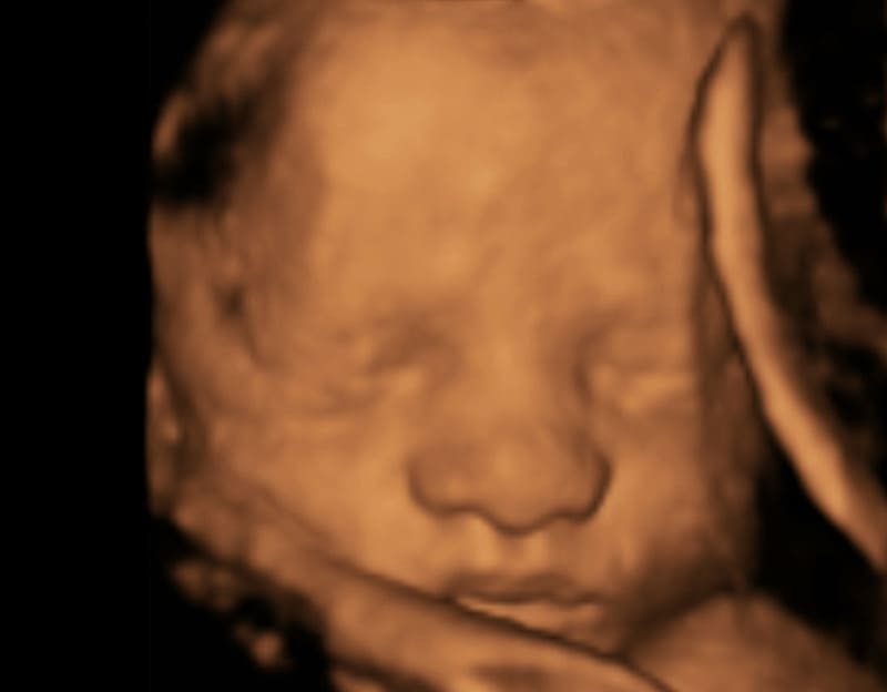 赤ちゃんの3d 4dエコー写真 実際の顔と比較してみたら似てた 旅するダンサー自由記