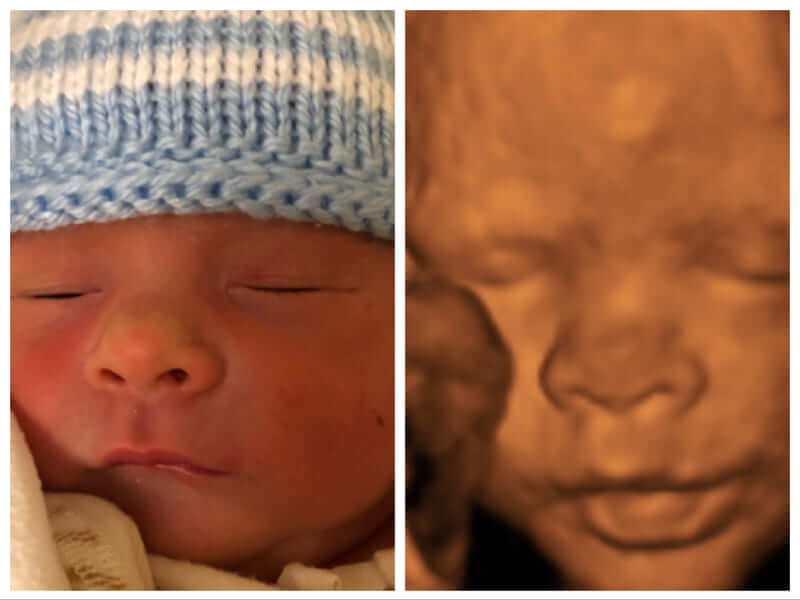 【赤ちゃんの3D/4Dエコー写真】実際の顔と比較してみたら似てた!! 旅するダンサー自由記