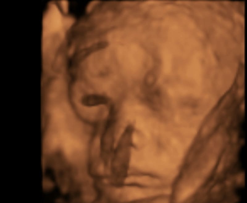 赤ちゃんの3d 4dエコー写真 実際の顔と比較してみたら似てた 旅するダンサー自由記